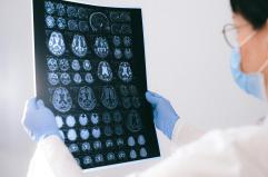 Un radiotracciante per l'analisi precoce di Alzheimer e Parkinson: lo studio pugliese passa alla fase 2