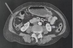 Corato, va in ospedale per un mal di pancia e le scoprono un grosso tumore benigno al colon