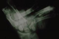 Petardi, due amputazioni a Bari: l&rsquo;allarme del Policlinico prima di Capodanno con un video shock