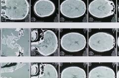 Glioblastoma, le molecole naturali migliorano la chemioterapia