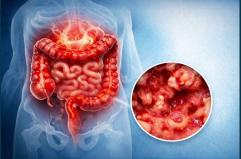 Colite ulcerosa, nuove opzioni terapeutiche