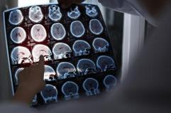 Nuove molecole e bersagli, così si evolve la terapia contro l'Alzheimer: il punto