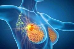 Cancro seno iniziale Her2+, con anticorpo farmaco-coniugato -53% recidiva