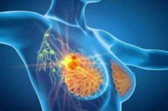 Cancro seno, con profilazione molecolare e terapie target migliori prospettive di cura