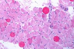 Malattie rare, risultati positivi a 5 anni per vamorolone in distrofia Duchenne