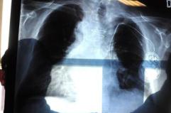 Polmonite, ogni anno in Italia 150mila ricoveri e 9mila morti: i sintomi