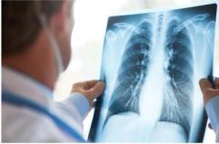 Curare il cancro al polmone senza chirurgia, prima italiana all'Ieo di Milano