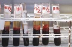 Hiv, Andreoni: "Terapie long acting migliorano aderenza e fermano trasmissione virus"