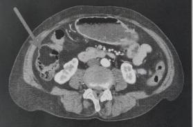 Corato, va in ospedale per un mal di pancia e le scoprono un grosso tumore benigno al colon
