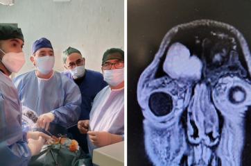 Bari, 37enne recupera la vista dopo un intervento d&rsquo;urgenza al Policlinico: aveva una grave complicanza sinusale