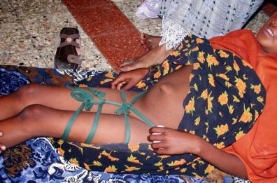 Mutilazioni genitali femminili 