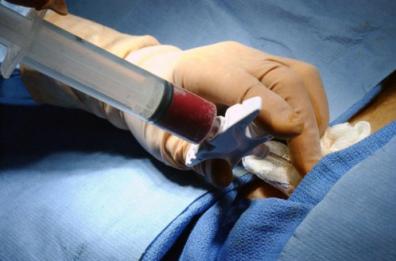 Bari, dona il midollo osseo e salva una vita: eseguito un nuovo prelievo al Policlinico