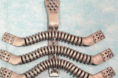 Tumori, protesi con stampa 3 D 
al posto di sterno e 6 costole
Trapianto da film per una pugliese