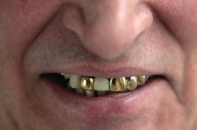 Nipote ruba denti d'oro al nonno, li sostituisce con molliche di pane