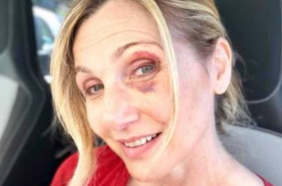 Lorella Cuccarini cade per strada: la foto col volto tumefatto su Instagram