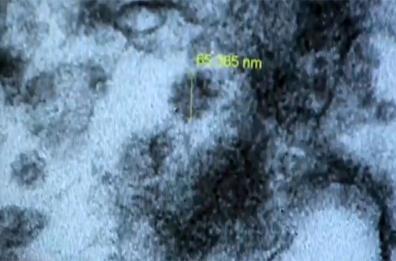 Coronavirus, Covid nel rene: scoperta europea al Negri di Bergamo