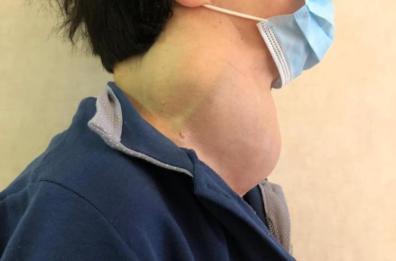 Bari, rimosso grosso tumore alla tiroide: paziente rischiava di soffocare