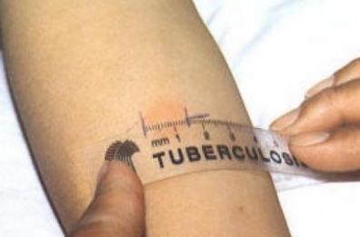 Si ammala di tubercolosi, vigile di Turi in isolamento al Policlinico di Bari