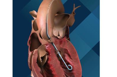 Foggia, al Riuniti per la prima volta intervento di angioplastica coronarica con cuore artificiale