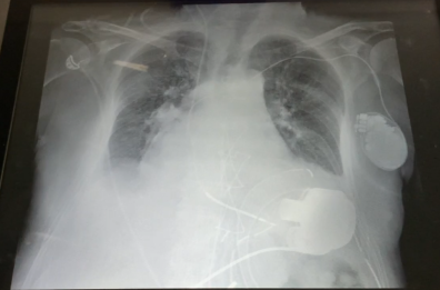 Cuore artificiale di ultima generazione impiantato al Policlinico di Bari