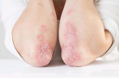 Artrite psoriasica, ok al farmaco-lucchetto