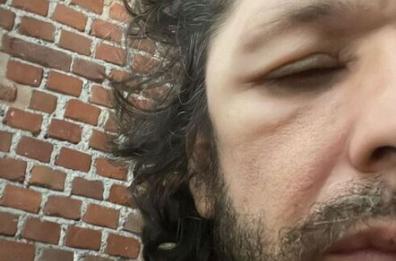 Paura per Ermal Meta: «Da giorni mi si gonfiano parti del viso e della testa»