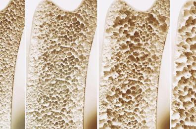 Osteoporosi, a Bari esperti internazionali per il XXII congresso nazionale