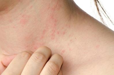 Allergie e dermatiti: «Salviamo la nostra pelle»