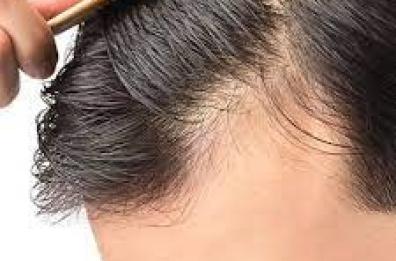 Puglia, il Consiglio approva una legge per i trapianti di capelli