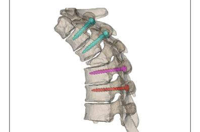 Bari, all'ospedale Di Venere mascherine vertebrali stampate in 3D per interventi sulla colonna
