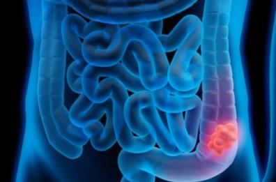 Lo studio giapponese: proteine animali per fermare i tumori all'intestino. «Non è vero che la carne fa sempre male»