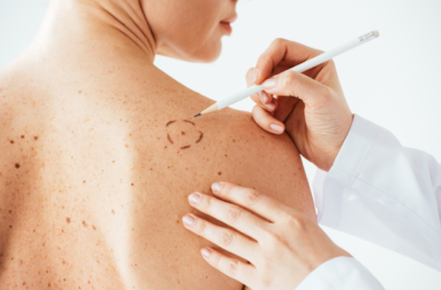 L’importanza di chiamarsi melanoma