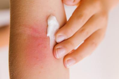 Salviamo la nostra pelle e sarà subito salute e bellezza: la dermatite atopica