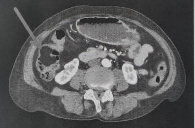 Corato, va in ospedale per un mal di pancia e le scoprono un grosso tumore benigno al colon