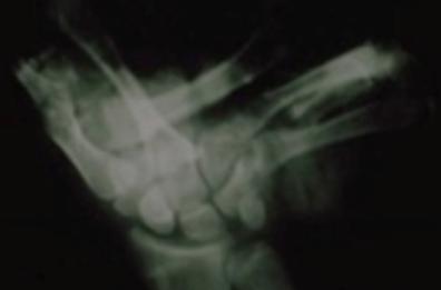 Petardi, due amputazioni a Bari: l&rsquo;allarme del Policlinico prima di Capodanno con un video shock