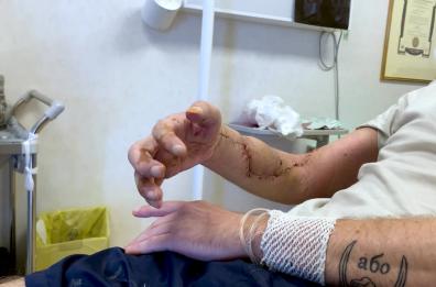 Policlinico Bari, ortoplastica per ricostruire il braccio di un militare ucraino ferito in guerra&nbsp;