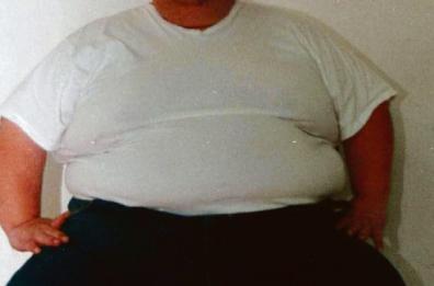 Obesità, con l’endoscopia meno rischi per la bilancia
