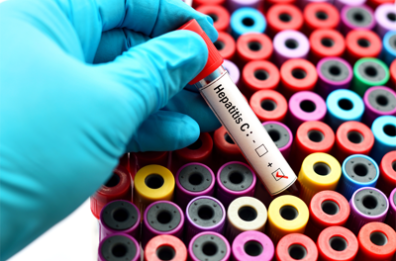 Epatite C, al via il piano eradicare il virus in Puglia