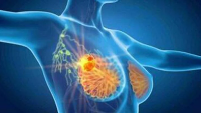 Cancro seno, con profilazione molecolare e terapie target migliori prospettive di cura