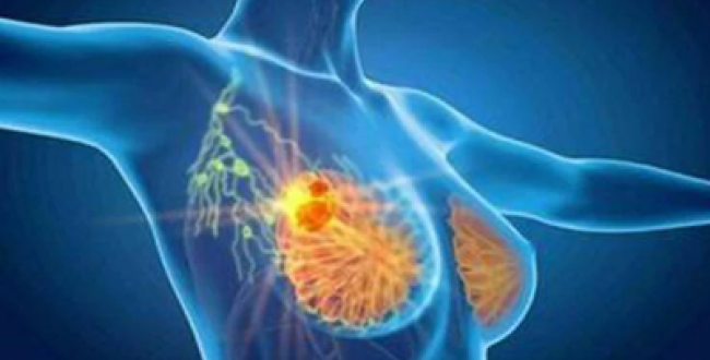 Cancro seno, con profilazione molecolare e terapie target migliori prospettive di cura