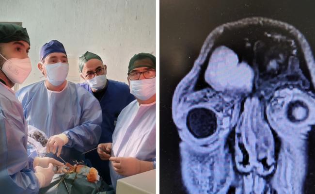 Bari, 37enne recupera la vista dopo un intervento d&rsquo;urgenza al Policlinico: aveva una grave complicanza sinusale