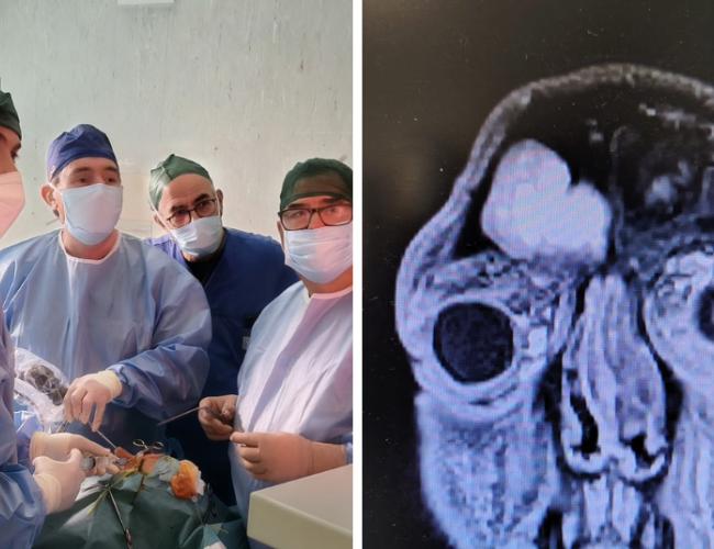 Bari, 37enne recupera la vista dopo un intervento d&rsquo;urgenza al Policlinico: aveva una grave complicanza sinusale