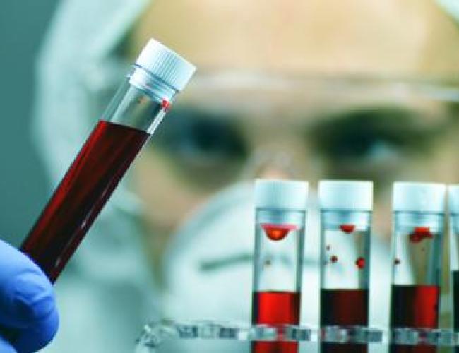 Alzheimer, allo studio esame del sangue per aiutare diagnosi precoce