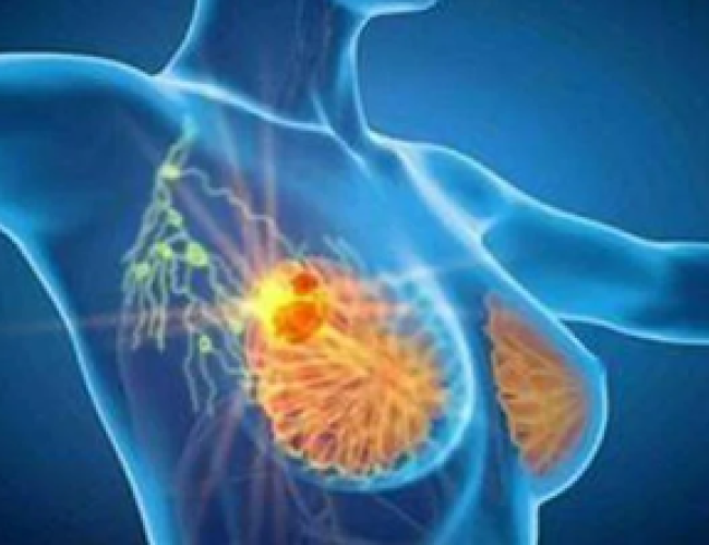 Cancro seno, con profilazione molecolare e terapie target migliori prospettive di cura