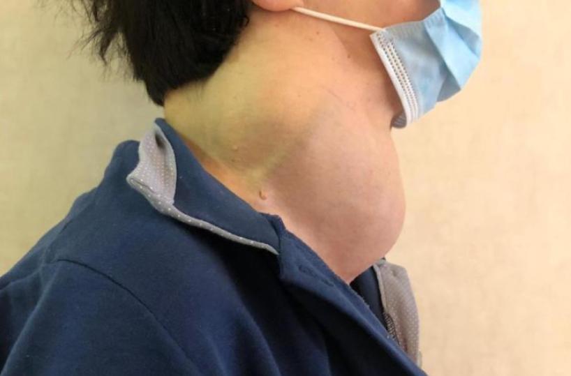 Bari, rimosso grosso tumore alla tiroide: paziente rischiava di soffocare