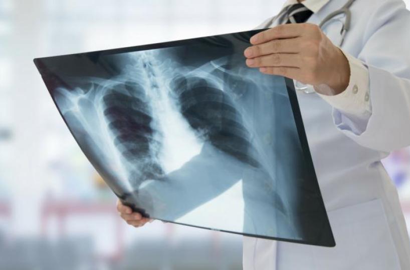 L'intelligenza artificiale per diagnosticare il Covid con i raggi X: la tesi di laurea a Lecce