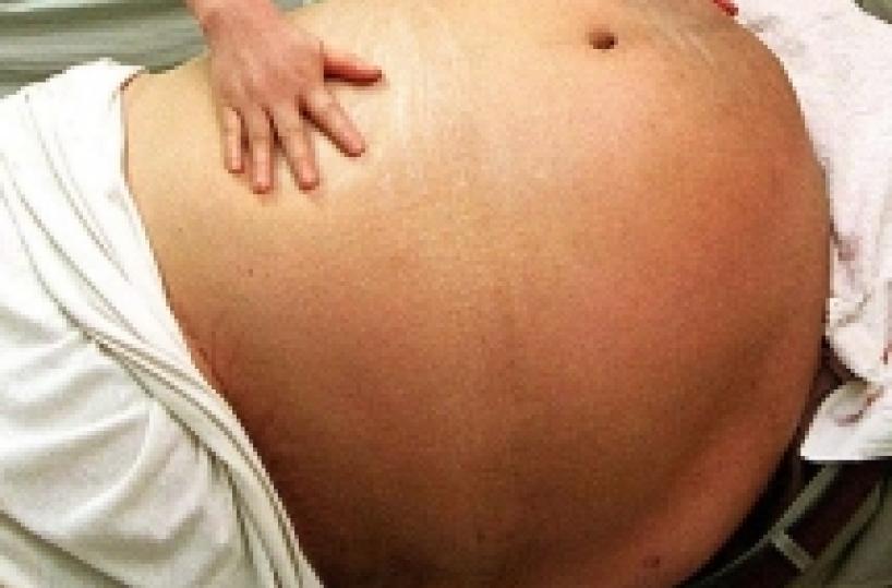 Sanità, in Puglia è allarme obesità ma per operarsi si va in Lombardia