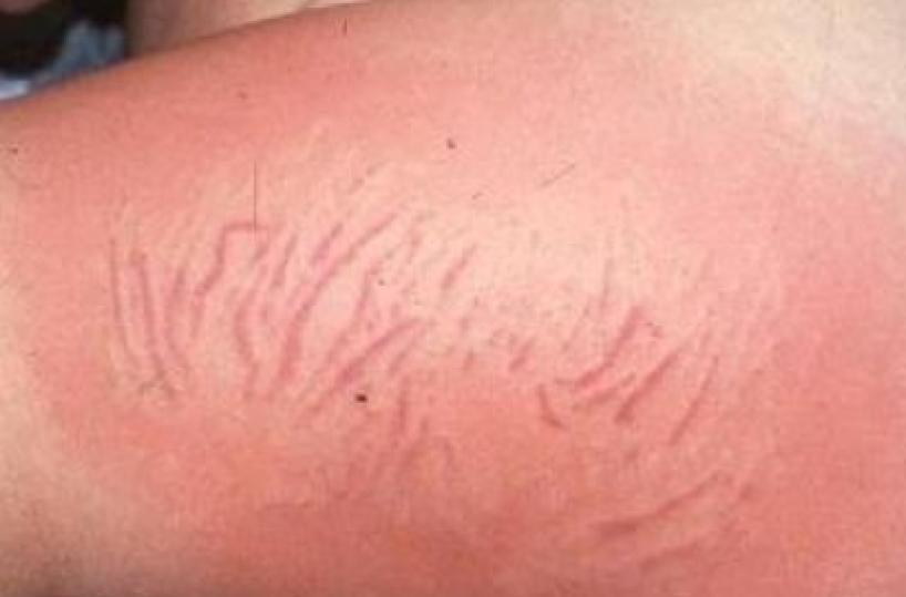 Sei bambini in ospedale a causa delle «punture» da anemone marino