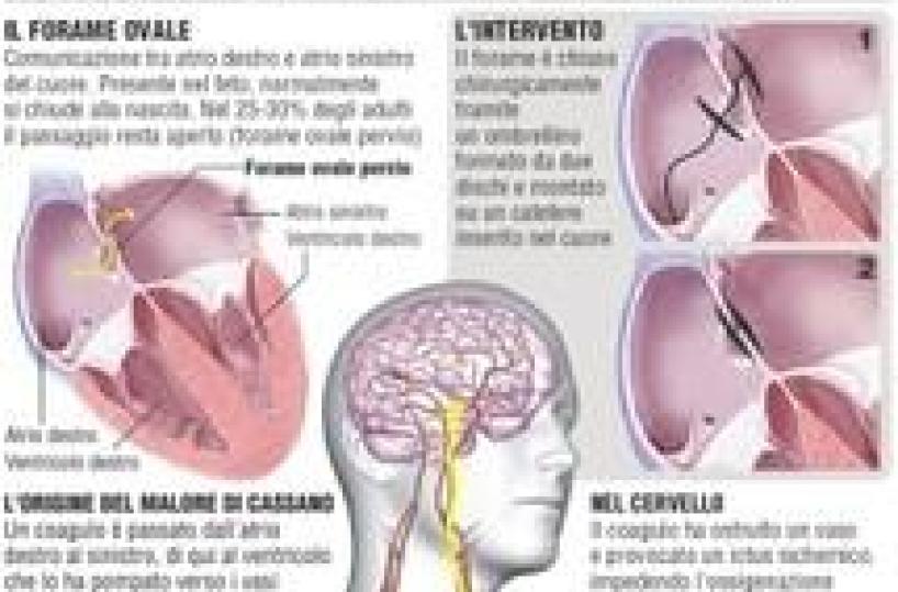 Italians discover molecule that 'brakes' heart disease