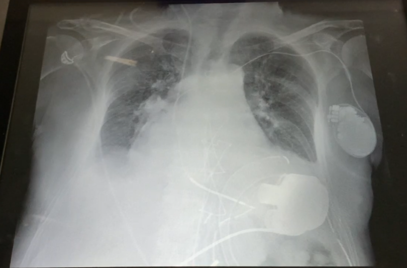 Cuore artificiale di ultima generazione impiantato al Policlinico di Bari